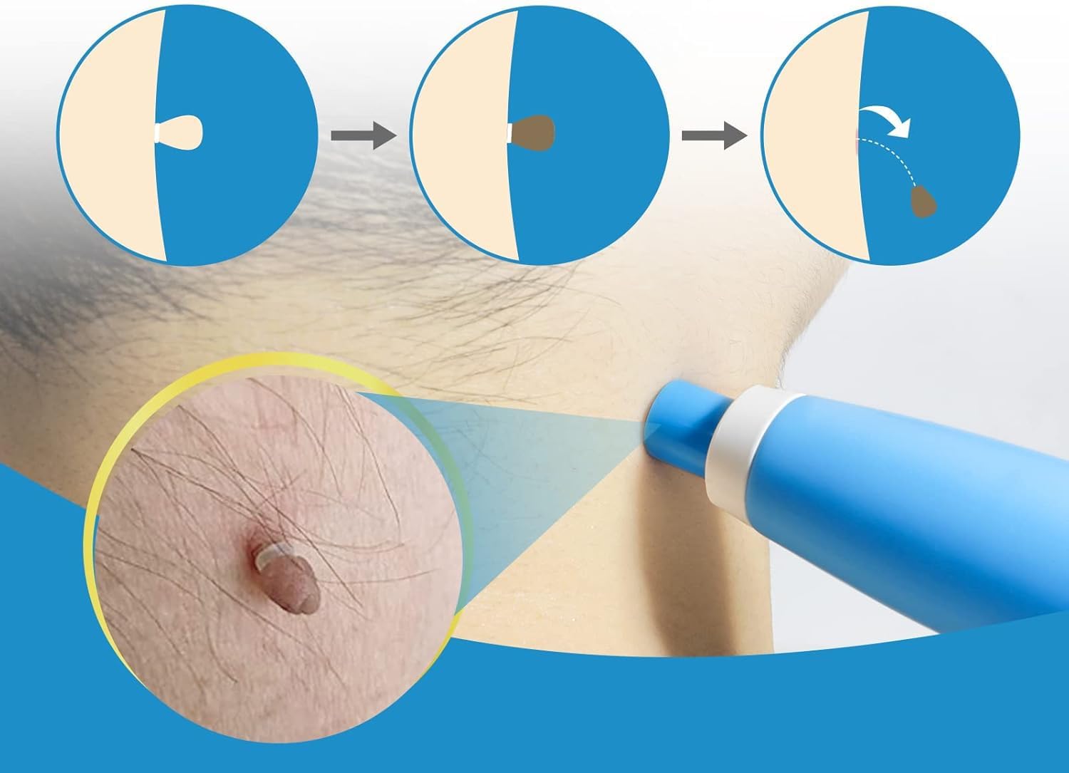 Painless Auto Skin Tag & Mole  - Health Wellness review and price
