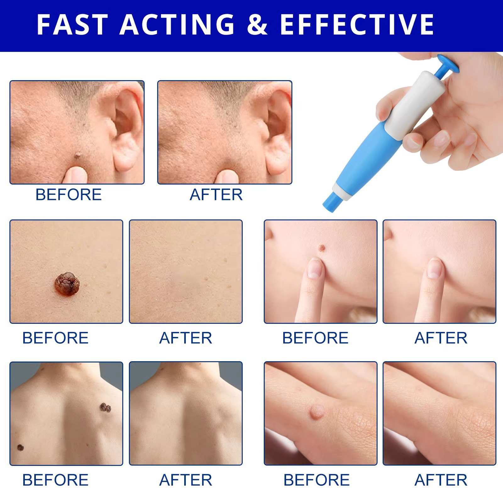 Painless Auto Skin Tag & Mole  - Health Wellness review and price